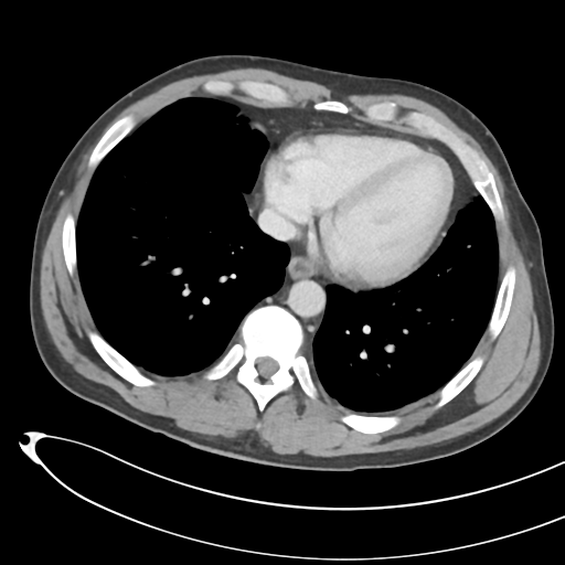 File:Necrotizing pancreatitis with acute necrotic collections (Radiopaedia 38829-41012 B 5).png