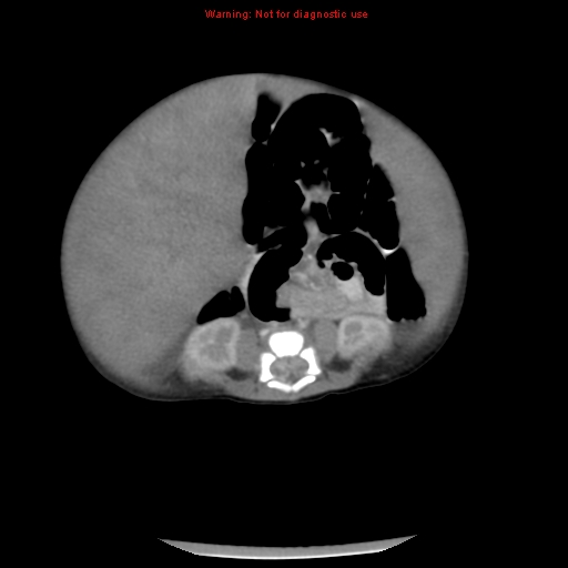 File:Neonatal neuroblastoma (Radiopaedia 9564-10223 A 34).jpg