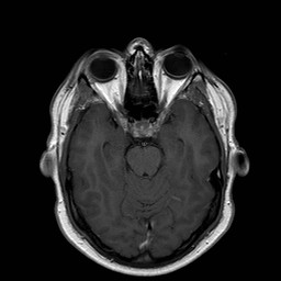 File:Neuro-Behcet's disease (Radiopaedia 21557-21505 Axial T1 C+ 8).jpg