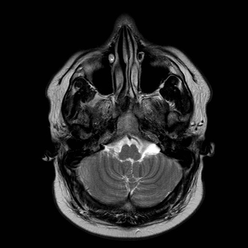 File:Neuro-Behcet's disease (Radiopaedia 21557-21505 Axial T2 4).jpg