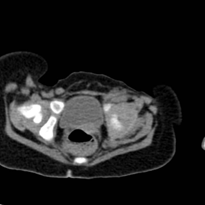 Neuroblastoma with skull metastases (Radiopaedia 30326-30960 Axial non-contrast 58).jpg