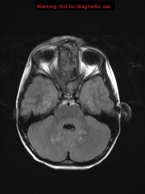 File:Neurofibromatosis type 1 with optic nerve glioma (Radiopaedia 16288-15965 Axial FLAIR 18).jpg