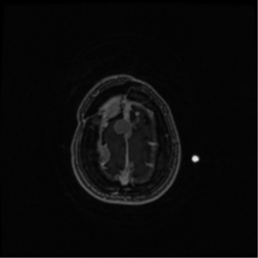 Neurofibromatosis type 2 (Radiopaedia 45229-49244 Axial T1 C+ 104).png
