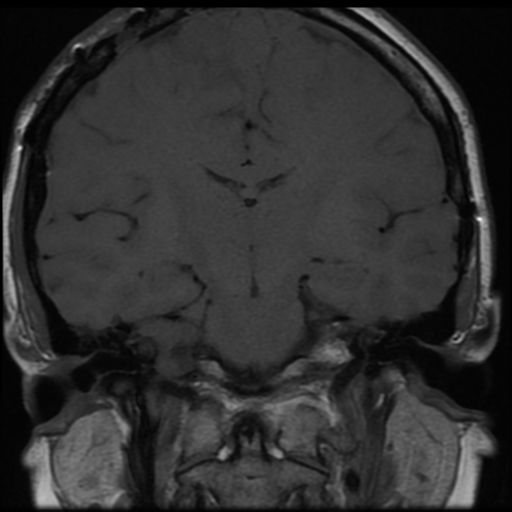 File:Neurofibromatosis type 2 (Radiopaedia 45229-49251 Coronal T1 7).png