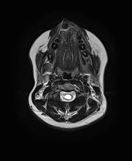 File:Neurofibromatosis type 2 (Radiopaedia 66211-75401 Axial T2 3).jpg