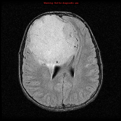 File:Neurofibromatosis type 2 (Radiopaedia 8953-9730 Axial FLAIR 17).jpg