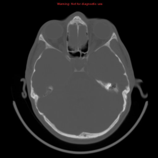 File:Neurofibromatosis type 2 (Radiopaedia 8953-9732 Axial bone window 11).jpg