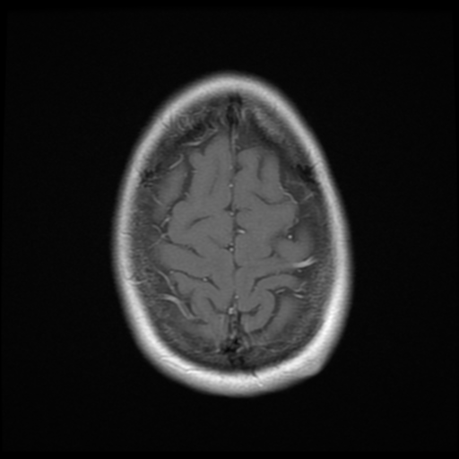 File:Neurofibromatosis type 2 - bilateral acoustic neuromata (Radiopaedia 40060-42566 Axial T1 C+ 19).png