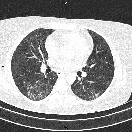 Non-specific interstitial pneumonia (Radiopaedia 83185-97567 Axial lung window 35).jpg