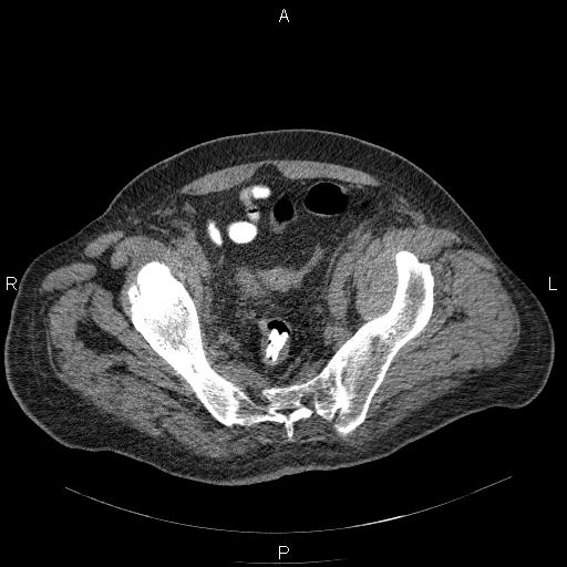File:Non Hodgkin lymphoma in a patient with ankylosing spondylitis (Radiopaedia 84323-99624 Axial non-contrast 58).jpg