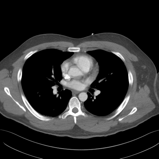 File:Normal CTA thorax (non ECG gated) (Radiopaedia 41750-44704 A 49).png