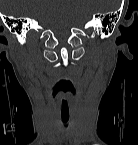 File:Normal CT cervical spine - 12-year-old (Radiopaedia 55352-61775 Coronal bone window 44).jpg