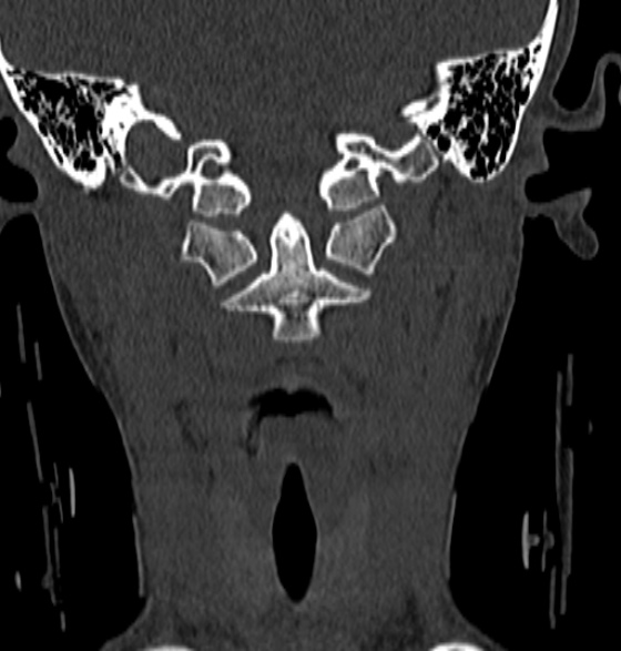 File:Normal CT cervical spine - 12-year-old (Radiopaedia 55352-61775 Coronal bone window 54).jpg