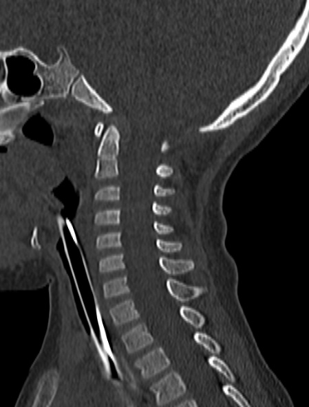 Normal CT cervical spine - pediatric (Radiopaedia 52549-58462 Sagittal bone window 106).jpg