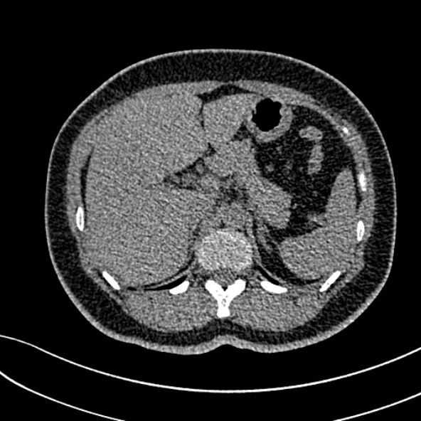 Normal CT chest- adult female (Radiopaedia 52522-58428 Axial non-contrast 133).jpg