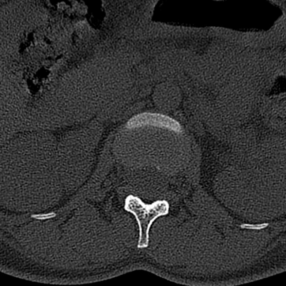 File:Normal CT lumbar spine (Radiopaedia 53981-60118 Axial bone window 17).jpg