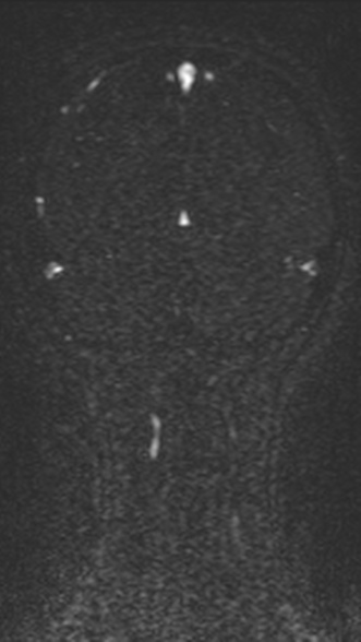 Normal MRI brain with MRV- teenager (Radiopaedia 49425-54553 Coronal MRV 191).jpg