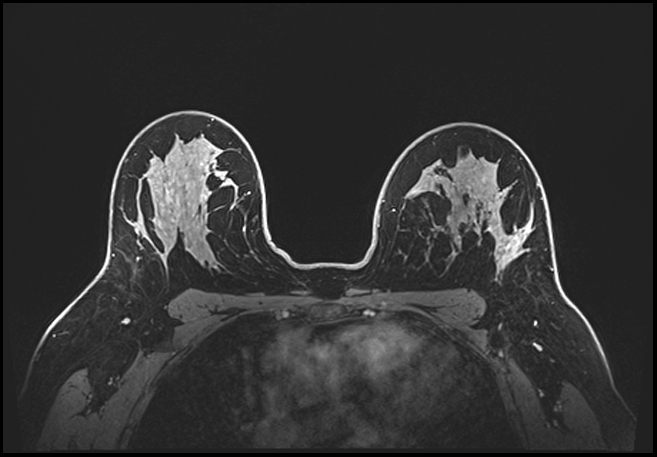 Normal breast MRI - dense breasts (Radiopaedia 80454-93850 C 142).jpg