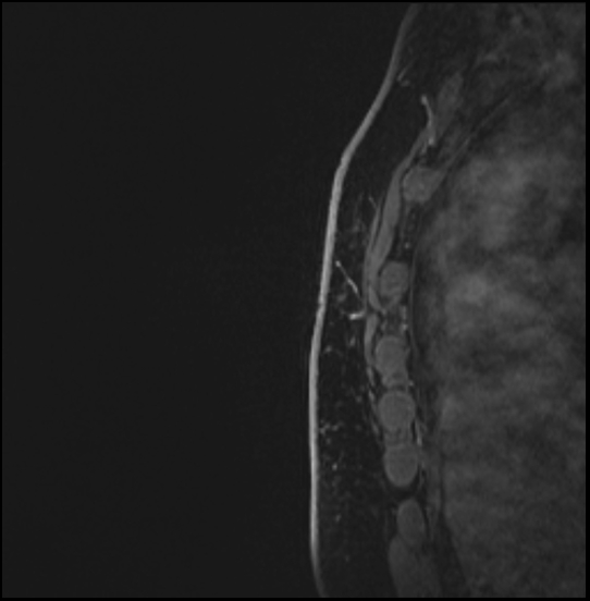 Normal breast MRI - dense breasts (Radiopaedia 80454-93850 I 171).jpg