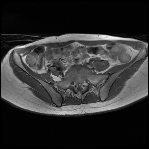 File:Normal female pelvis MRI (retroverted uterus) (Radiopaedia 61832-69933 Axial T1 7).jpg