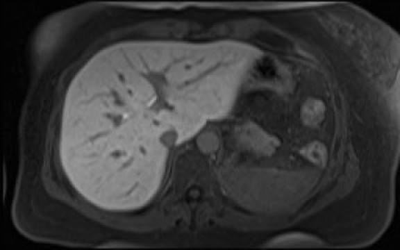 File:Normal hepatobiliary phase liver MRI (Radiopaedia 58968-66230 A 32).jpg