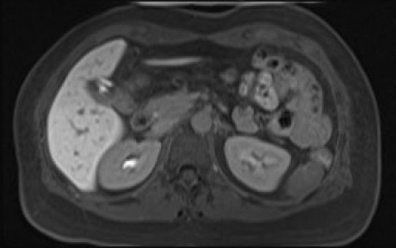 File:Normal hepatobiliary phase liver MRI (Radiopaedia 58968-66230 A 51).jpg