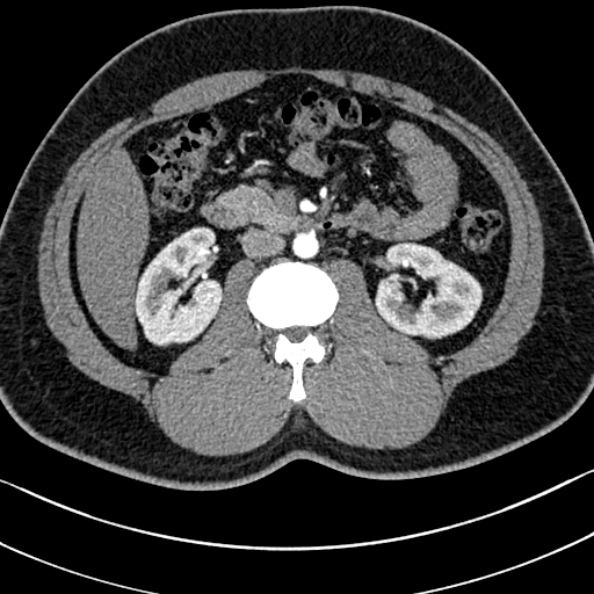Normal kidneys on 4-phase CT study (Radiopaedia 25889-26038 B 45).jpg
