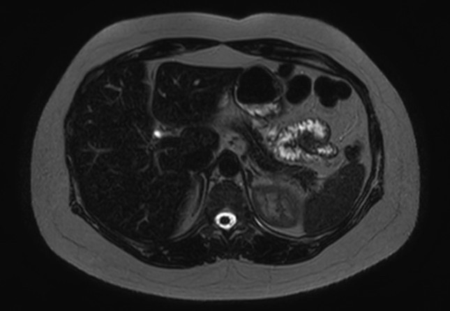 File:Normal liver MRI with Gadolinium (Radiopaedia 58913-66163 E 21).jpg