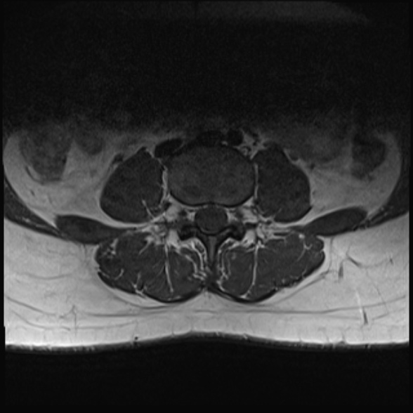 File:Normal lumbar spine MRI- 3 T (Radiopaedia 53280-59250 Axial 15).jpg