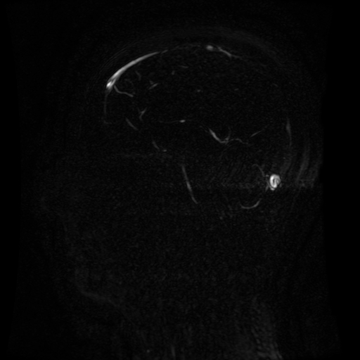 Normal noncontrast MR venography (Radiopaedia 87578-103957 A 83).jpg