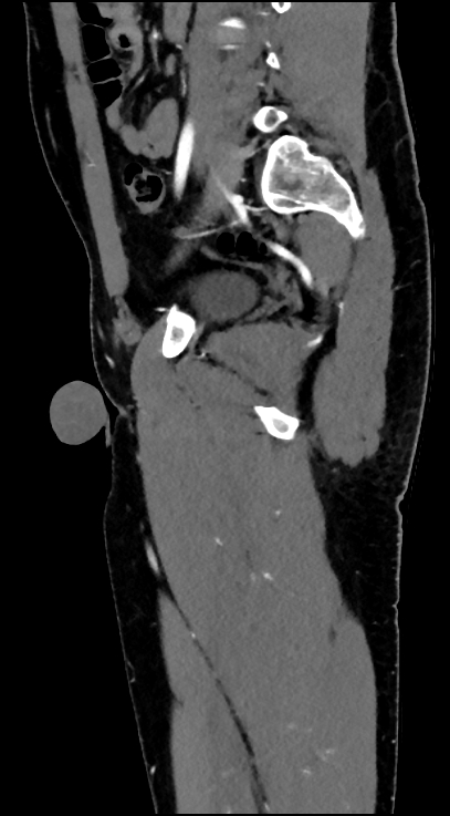 Normal pelvis CT angiogram (Radiopaedia 84966-100481 C 68).jpg