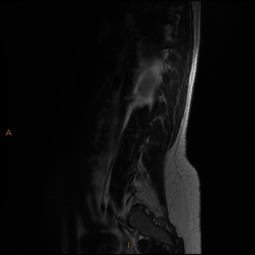 File:Normal spine MRI (Radiopaedia 77323-89408 Sagittal T2 2).jpg