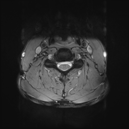 File:Normal trauma cervical spine (Radiopaedia 41017-43762 Axial T2 16).png