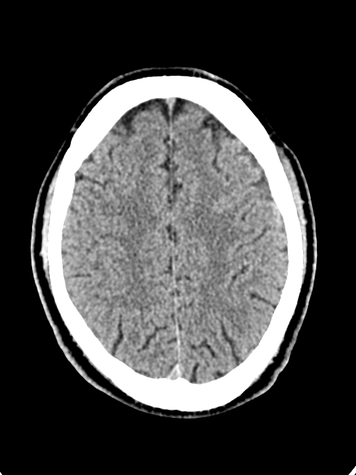 Normal trauma protocol brain and C-spine CT (Radiopaedia 83302-97709 Axial non-contrast 24).jpg