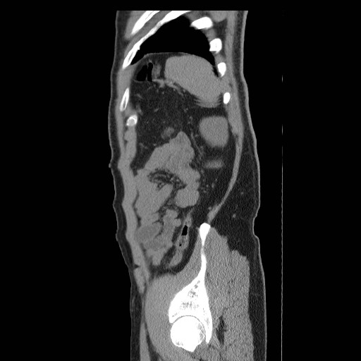 File:Obstructed kidney with perinephric urinoma (Radiopaedia 26889-27066 B 54).jpg