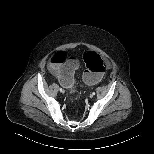 File:Obstructing sigmoid adenocarcinoma (Radiopaedia 58465-65619 A 132).jpg