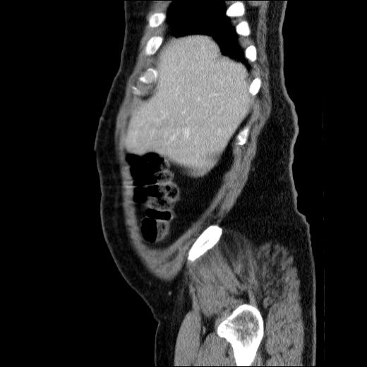 Obstructing ureteric calculus (Radiopaedia 49281-54373 C 76).jpg