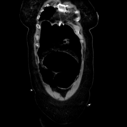 Obstructive distal colonic adenocarcinoma causing cecal perforation (Radiopaedia 86830-102989 C 51).jpg