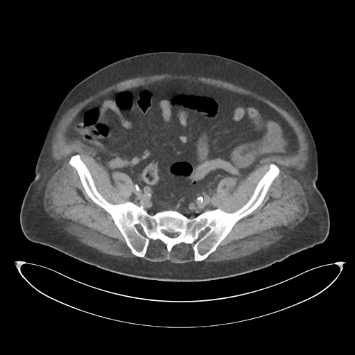 File:Obstructive pyelonephritis (Radiopaedia 46411-50844 Axial non-contrast 60).png