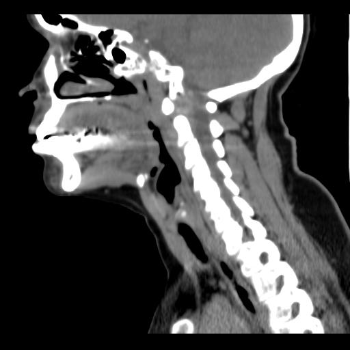 File:Obstructive sleep apnea (CT evaluation) (Radiopaedia 24304-24582 C 42).jpg