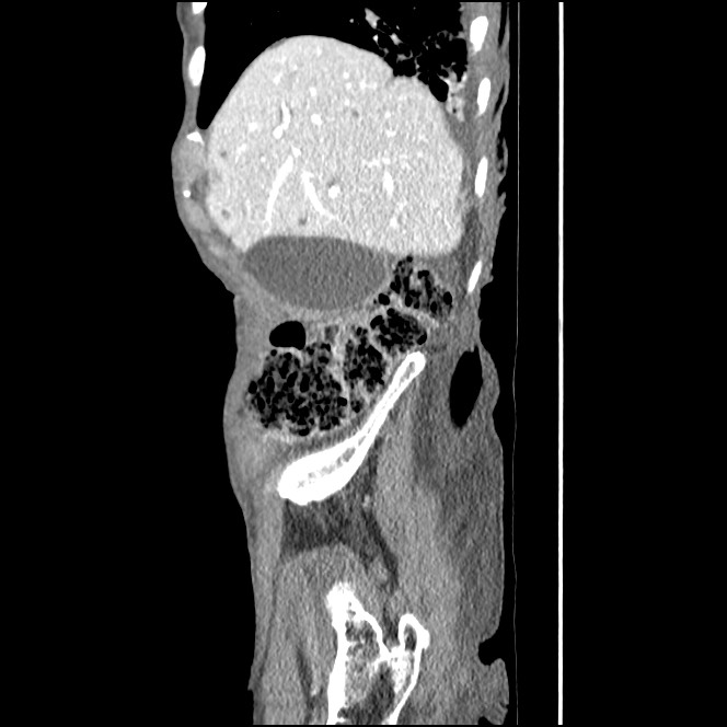 Obturator hernia causing small bowel obstruction (Radiopaedia 65522-74612 C 82).jpg