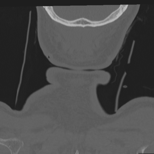 File:Occipital condyle fracture (Radiopaedia 33467-34517 Coronal bone window 77).png