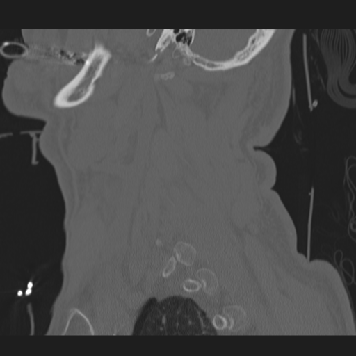 File:Occipital condyle fracture (Radiopaedia 33467-34517 Sagittal bone window 62).png