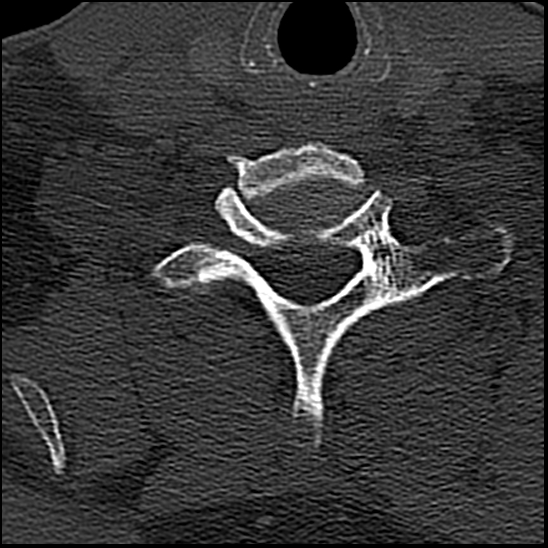 Occipital condyle fracture (type 1) (Radiopaedia 87670-104084 Axial bone window 72).jpg
