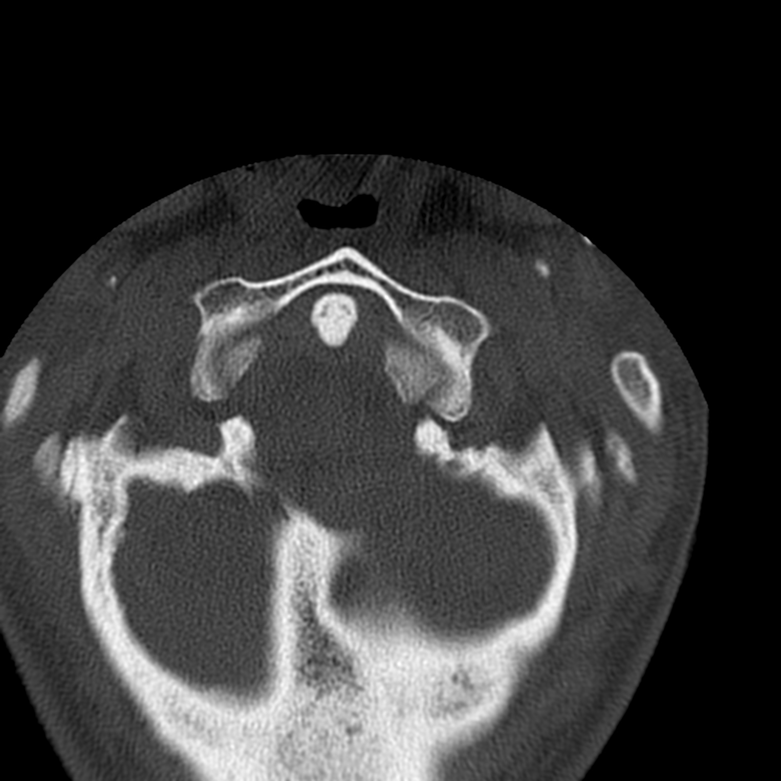 Occipital Condyle Fracture Radiopaedia 31755 32691 Axial Bone Window Nc Commons 4640
