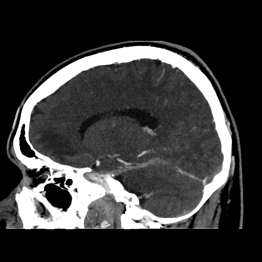Occipital extradural hematoma simulating venous sinus thrombosis (Radiopaedia 46514-50964 D 32).jpg