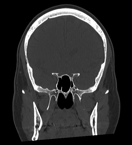 Occipital spur and Currarino type A atlas anomaly (Radiopaedia 87027-103285 Coronal bone window 66).jpg