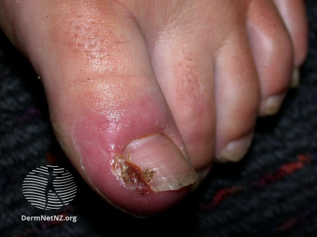 File:Paronychia and ingrown toenail in an athlete (DermNet NZ fungal-paron3).jpg
