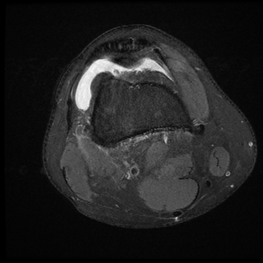 File:ACL acute full thickness tear - deep lateral femoral sulcus sign (Radiopaedia 38594-40740 Axial PD fat sat 7).jpg