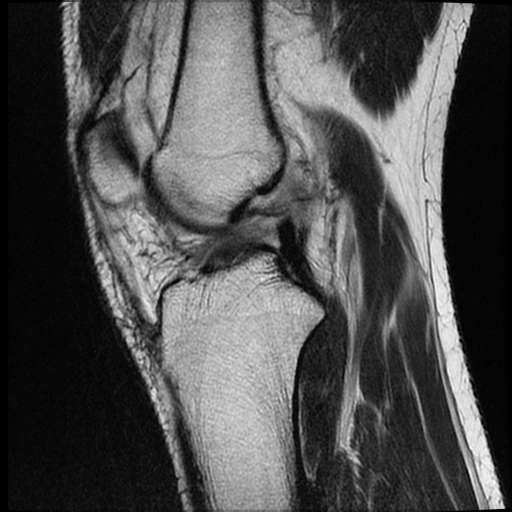 File:ACL acute full thickness tear - deep lateral femoral sulcus sign (Radiopaedia 38594-40740 Sagittal T2 10).jpg